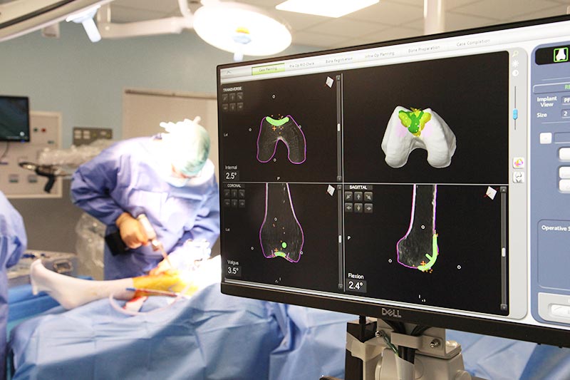 La planification 3D basée sur la tomodensitométrie améliore la préparation d'une opération de chirurgie orthopédique.